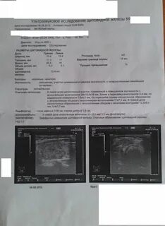 Очаговое образование правой доли