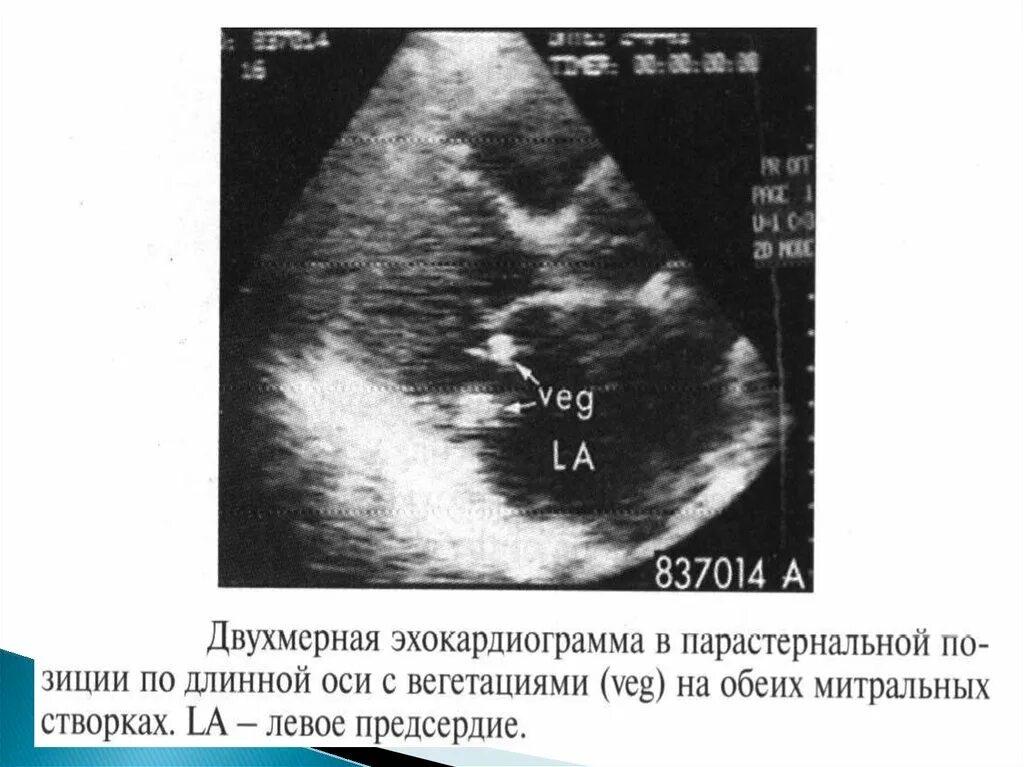 ЭХОКГ при инфекционном эндокардите аортального клапана. УЗИ сердца при инфекционном эндокардите. ЭХОКГ при инфекционном эндокардите. Инфекционный эндокардит ЭХОКГ. Вегетация сердца