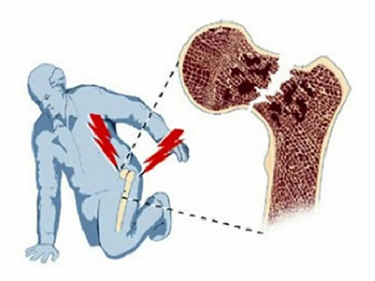 Перелом шейки бедра в пожилом возрасте. Факторы способствующие перелому шейки бедра. Осложнения перелома шейки бедра. Перелом шейки бедра у пожилых. Перелом шейки бедра симптомы.