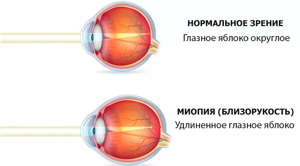 Миопия глазное яблоко. Форма глаза при близорукости. Глаз человека строение миопия. Неправильная форма глазного яблока при дальнозоркости. Зрение 6 10