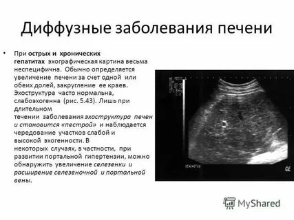 Структура поджелудочной диффузно неоднородная эхогенность повышена