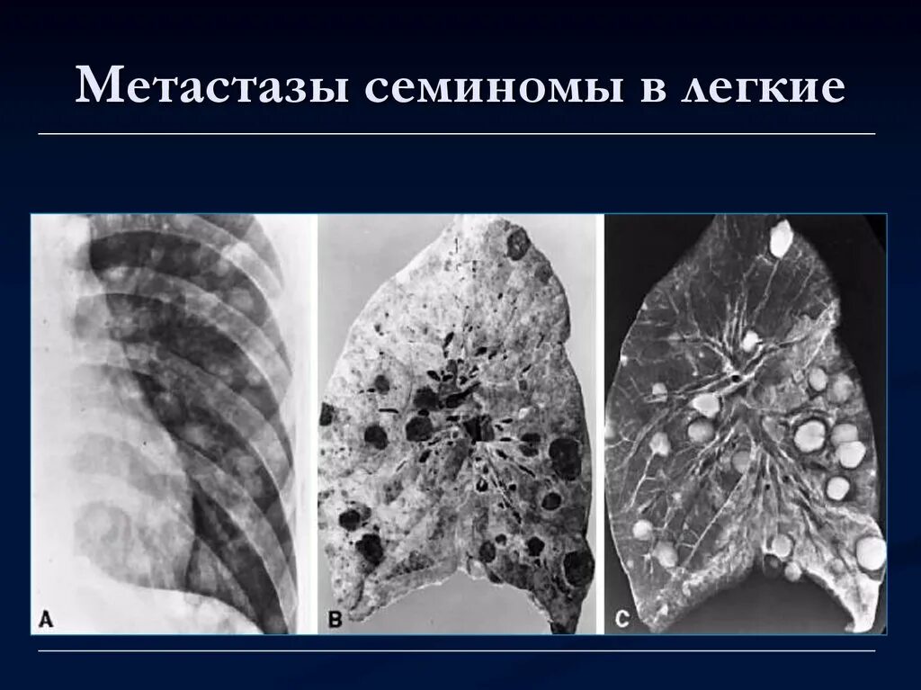 Метастазы семиномы в легкие.. Метастазирование в легкие. Метастатические опухоли легких. Признаки метастаз в легких