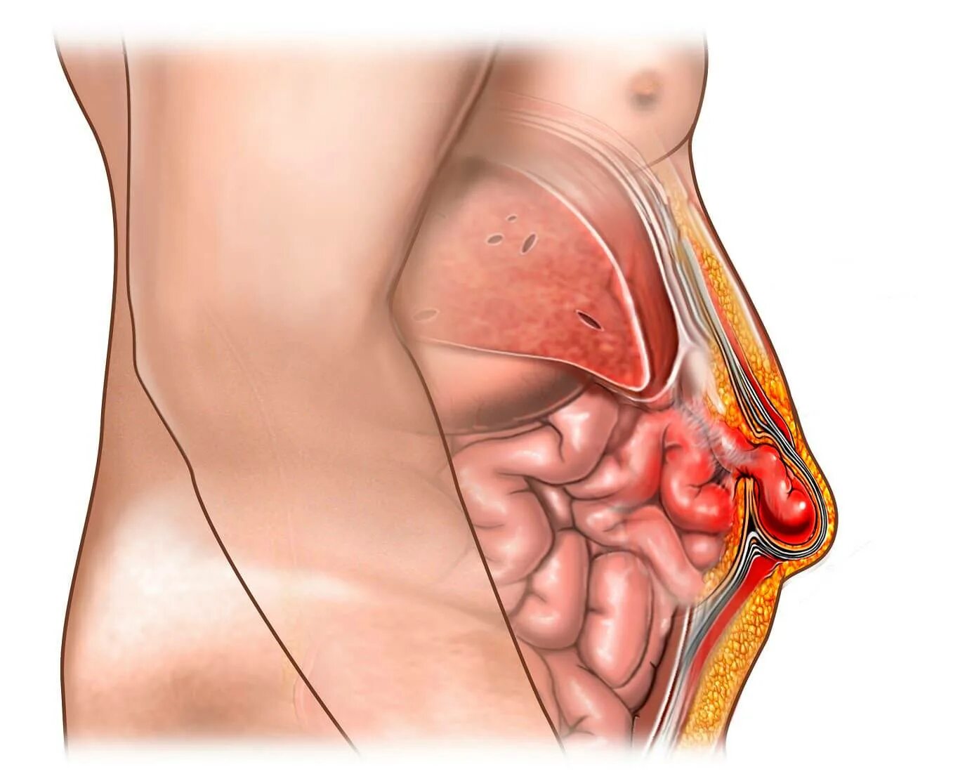 Колет внутри. Грыжа послеоперационный послеоперационная. Послеоперационная грыжа аппендикс. Послеоперационная вентральная грыжа грыжа.
