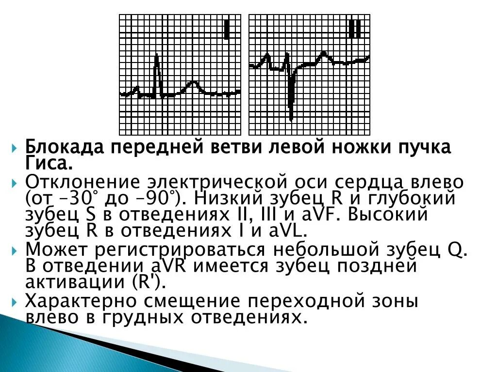 Неполная блокада передней. Блокада ЛНПГ на ЭКГ. Блокада передневерхнего разветвления левой ножки пучка Гиса на ЭКГ. Блокада задней ветви левой ножки пучка Гиса на ЭКГ. Блокада левой ножки пучка Гиса на ЭКГ.