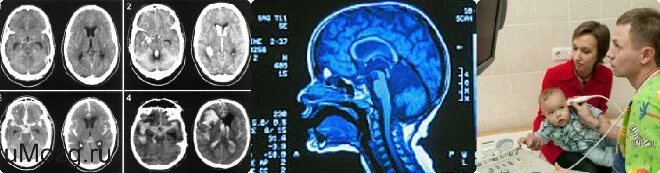 НСГ УЗИ головного мозга. Ультразвуковое исследование головного мозга - нейросонография (НСГ). Нейросонография мозолистое тело.
