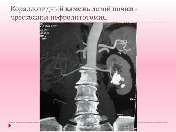 Конкремент латынь. Коралловидный камень левой почки. Коралловидный камень правой почки. Коралловидный камень в почке кт. Коралловидный камень почки СКТ.