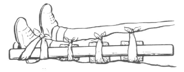 Кровотечение при открытом переломе голени. Иммобилизация коленного сустава. Наложение шины при переломе. Шина при переломе стопы. Иммобилизация голени шиной.
