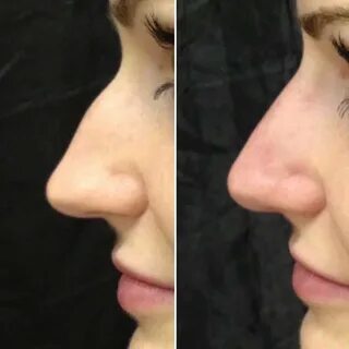Отзывы после ринопластики форум