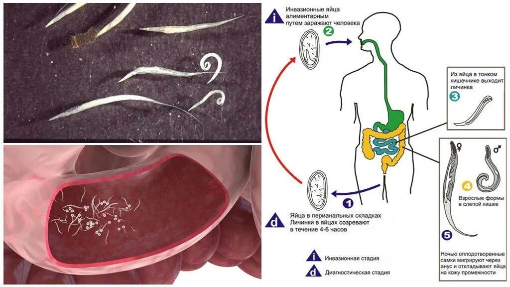 Черви паразиты Острица. Острица Enterobius vermicularis жизненный цикл. Глисты энтеробиоз острицы. Энтеробиоз острицы у детей.