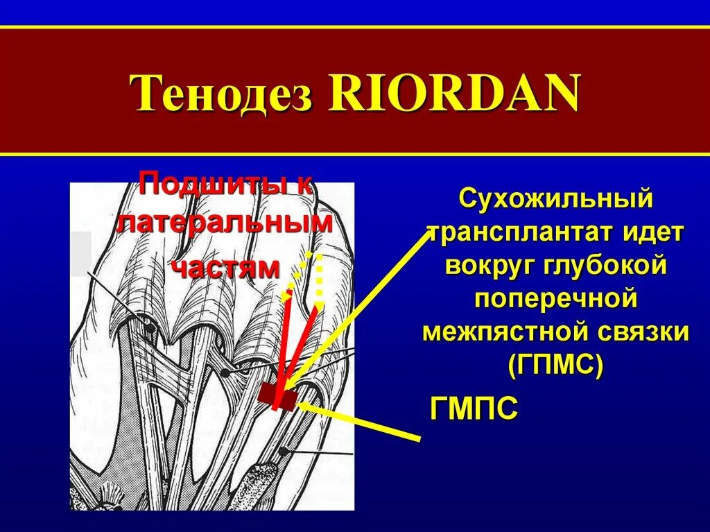 Сухожильный трансплантат. Суходильный транпспалнтат. Транспозиция сухожилий.