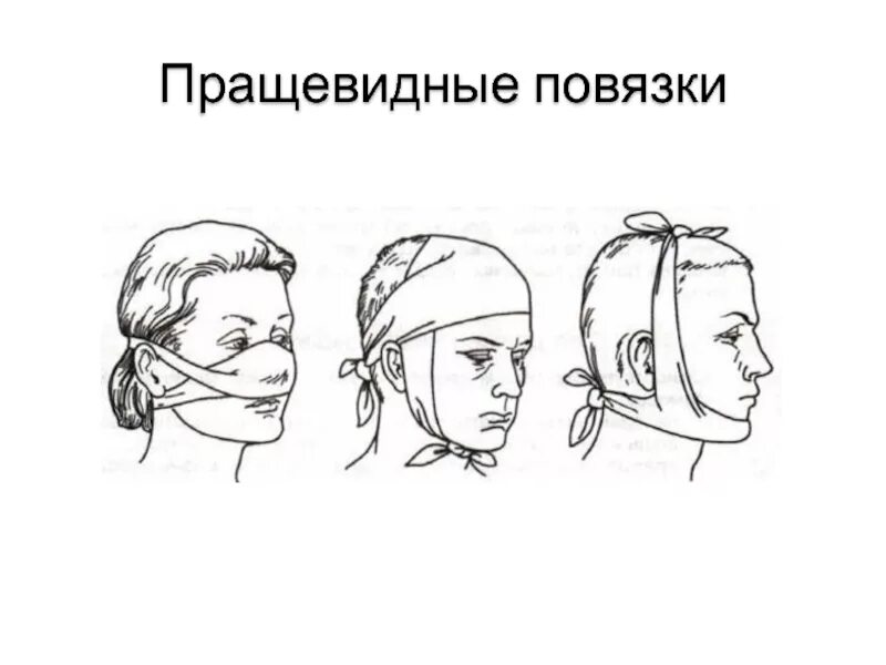 Техника наложения пращевидной повязки. Десмургия пращевидная повязка. Тип повязки пращевидная. Способ наложения пращевидной повязки голова. Пращевидная повязка показания.
