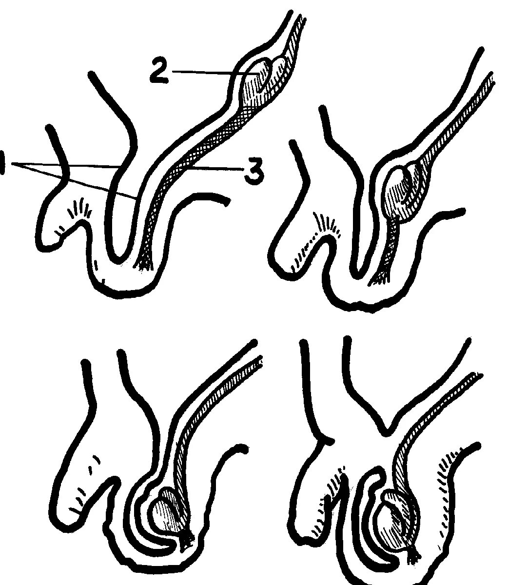 Крипторхизм и эктопия яичка. Неопущение яичек (крипторхизм). Крипторхизм эмбриогенез. Гипоспадия у детей клинические рекомендации. Не опускаются яички что делать