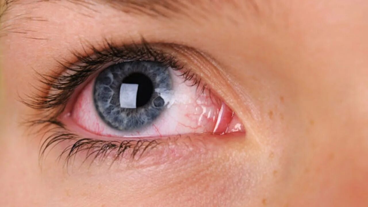 Эписклерит конъюнктивит. Здоровые глаза. Здоровый глаз человека.