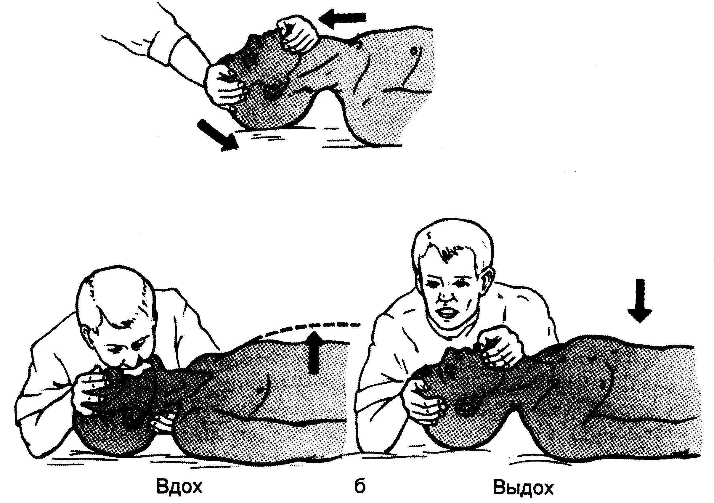 Сердечно-легочная реанимация изо рта в нос. Искусственное дыхание рот в нос. Искусственное дыхание изо рта в нос. Приемы искусственного дыхания