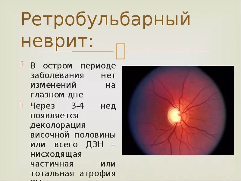 Нисходящая атрофия. Ретробульбарный неврит (папиллит). Ретробульбарный неврит периферическая форма. Ретробульбарный неврит глазное дно. Неврит зрительного нерва и ретробульбарный неврит.