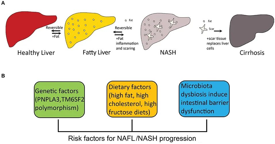 Pathogenesis of fatty Liver disease. Fatty Liver Nash. Fatty Liver распространенность. Pathogenesis of alcoholic Liver disease. Что такое стеатоз поджелудочной железы