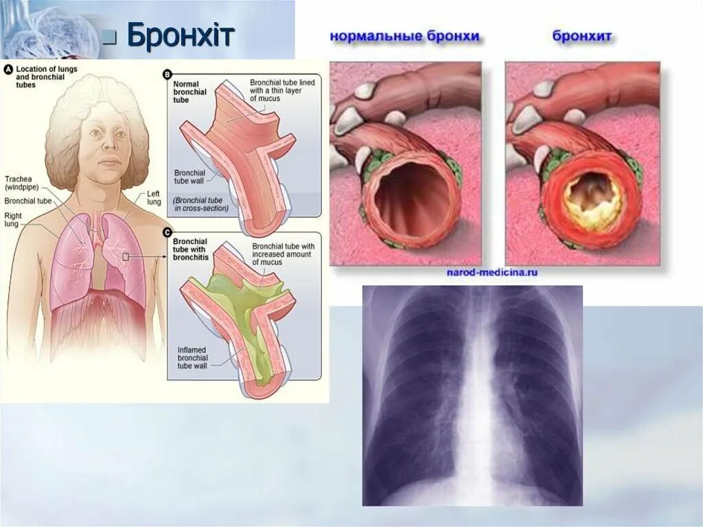 Бронхит россия. Бронхит последствия. Осложненный бронхит. Осложнения бронхита. Односторонний бронхит.