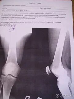 Доа коленного сустава 2 степени