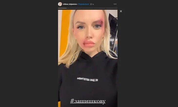 Милана Тюльпанова Кержакова фото до и после пластики, какие операции были?
