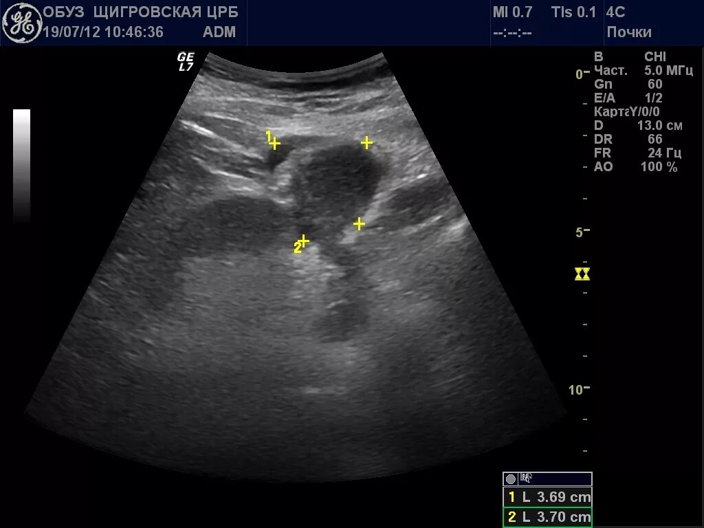 Доброкачественная опухоль почки на УЗИ. Объемное образование в почке на УЗИ что это. Опухоль почки почки УЗИ. Узи почка не видна