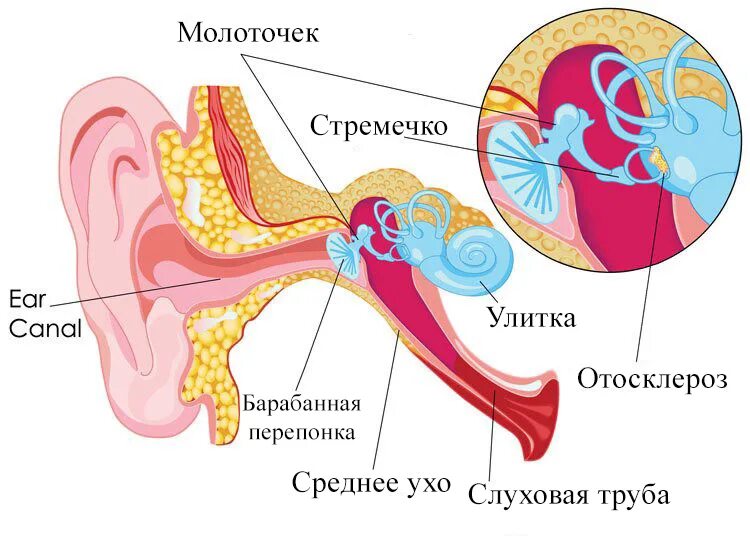 Внутреннее ухо лечение и симптомы. Тимпанальный отосклероз. Кохлеарный отосклероз. Кохлеарная форма отосклероза.