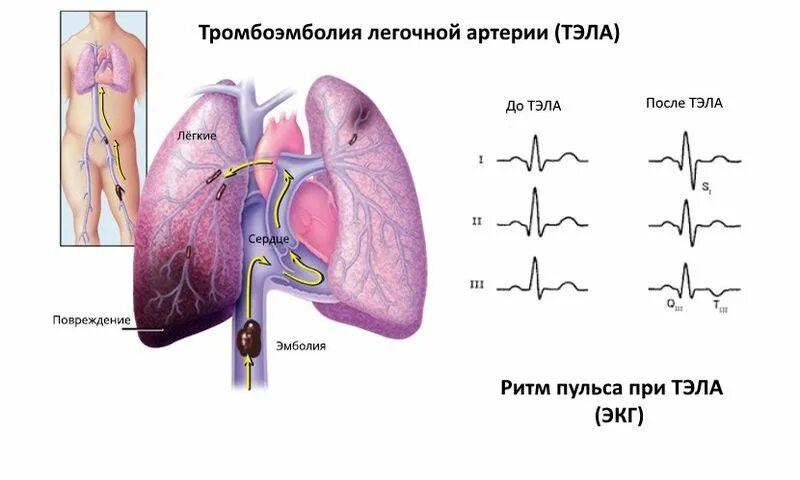 Давление в легочной артерии при Тэла. Тромбоэмболия легочной артерии гистология. Тромбоэмболия легочной артерии классификация. Тромбоэмболия легочной артерии рисунок.