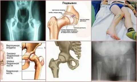 Подвывих сустава у ребенка