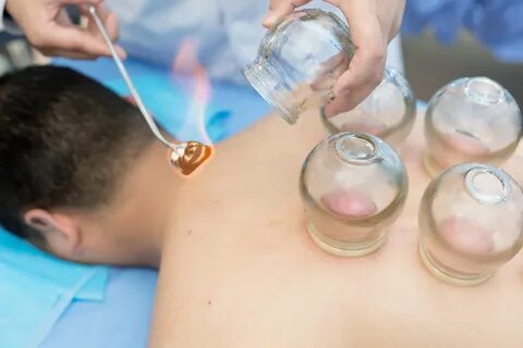 Cupping therapy Melbourne
