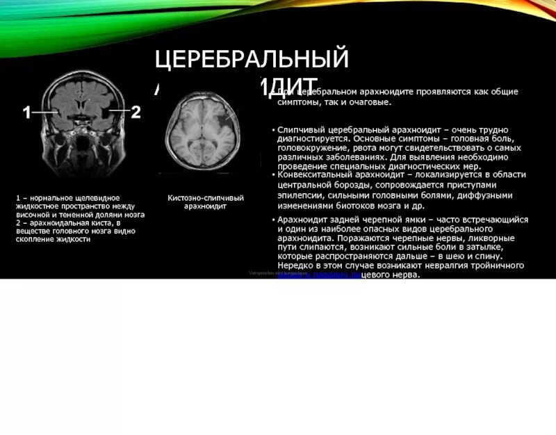 Слипчивый арахноидит мрт. Оптико-хиазмальный арахноидит мрт. Церебральный базальный арахноидит. Слипчивый арахноидит головного мозга мрт. Арахноидальные изменения ликворокистозного характера