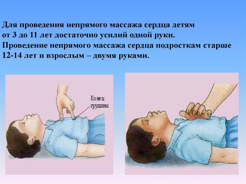 Непрямой массаж сердца у детей. У детей непрямой массаж сердца проводится:. Непрямой массаж сердца детям до года.