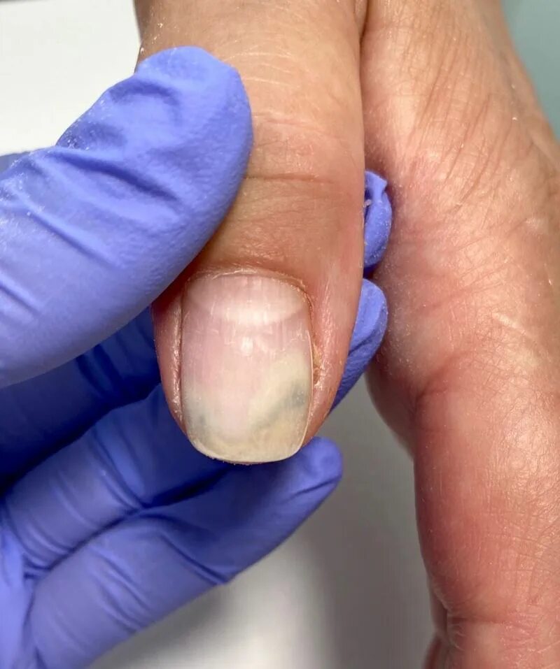 лечение пустот ногтей на руках