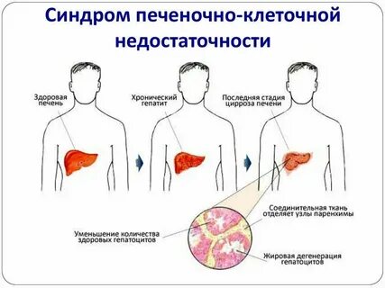 Ферментная недостаточность печени