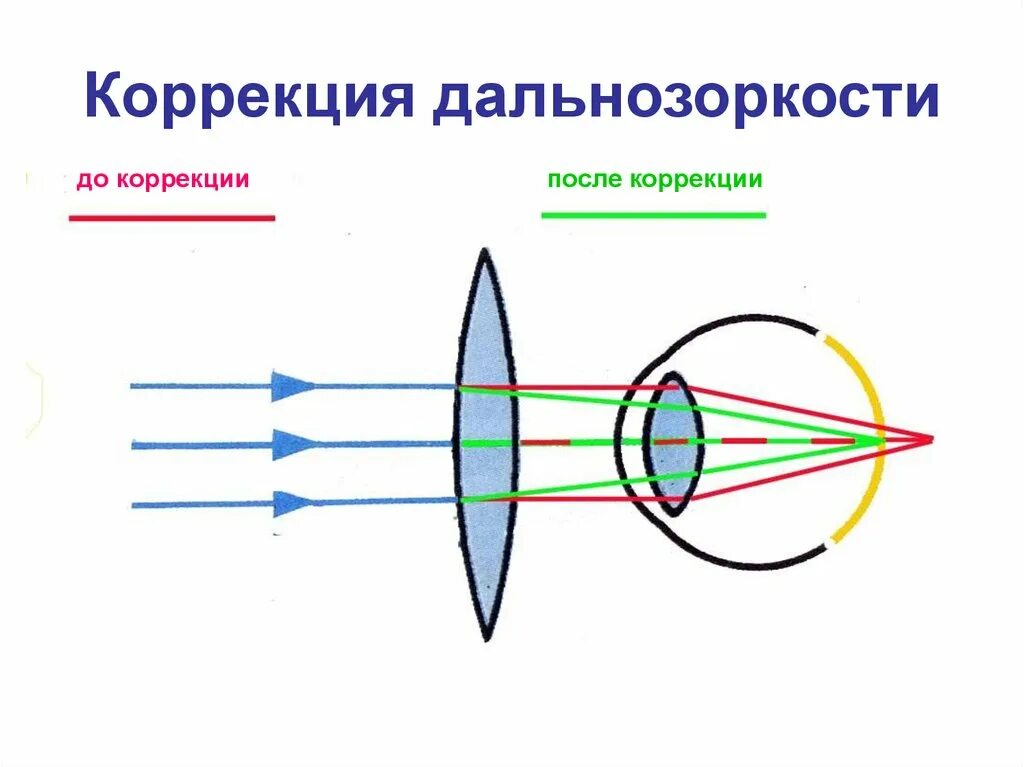 Как можно скорректировать дальнозоркость. Коррекция дальнозоркости. Коррекция гиперметропии. Корректировка дальнозоркости. Дальнозоркость методы ее коррекции.