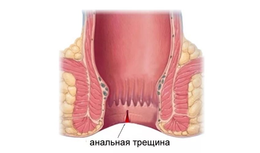 Трещина прямой кишки симптомы. Хроническая анальнальной трещина. Анальная трещина заднего прохода. Анальная трещина (трещина заднего прохода).