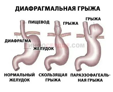 Что такое грыжа желудка