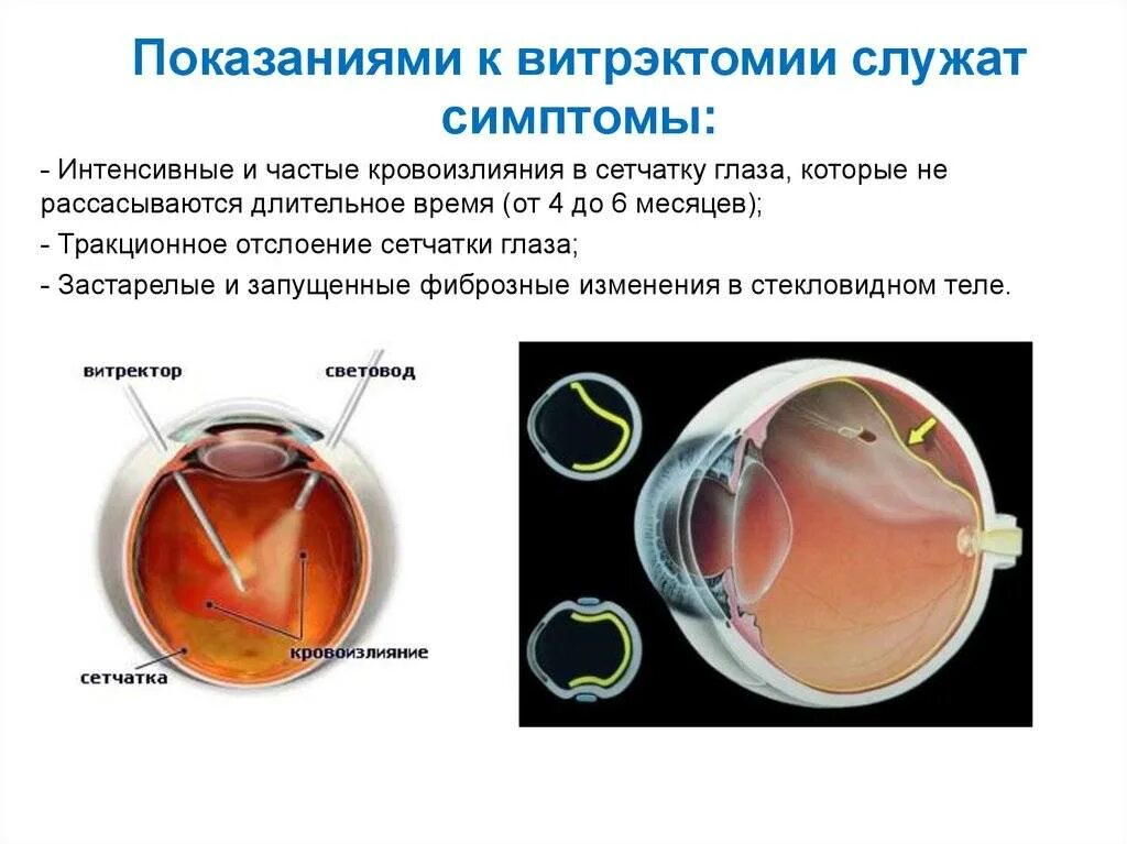 Отслойка сетчатки витрэктомия. Регматогенная отслойка сетчатки глаза. Витрэктомия при диабетической ретинопатии. Витрэктомия при отслойке сетчатки.