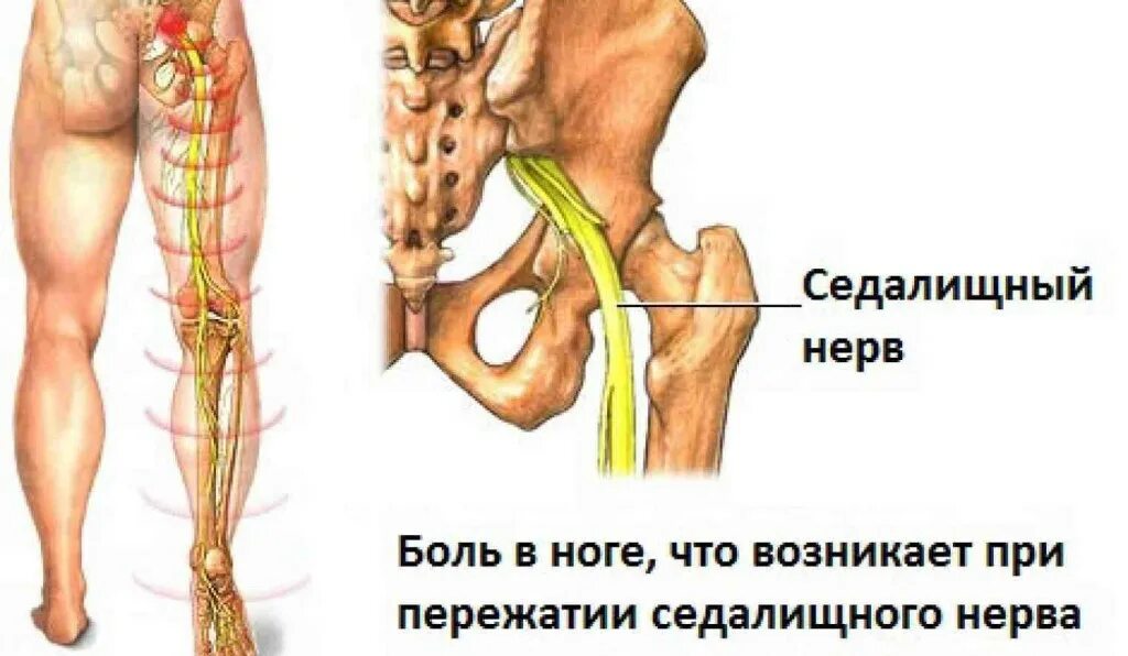 При защемлении седалищного в пояснице. Проекция седалищного нерва. Нервно седалищный нерв. Проекционная линия седалищного нерва. Ишиас - защемление седалищного нерва.