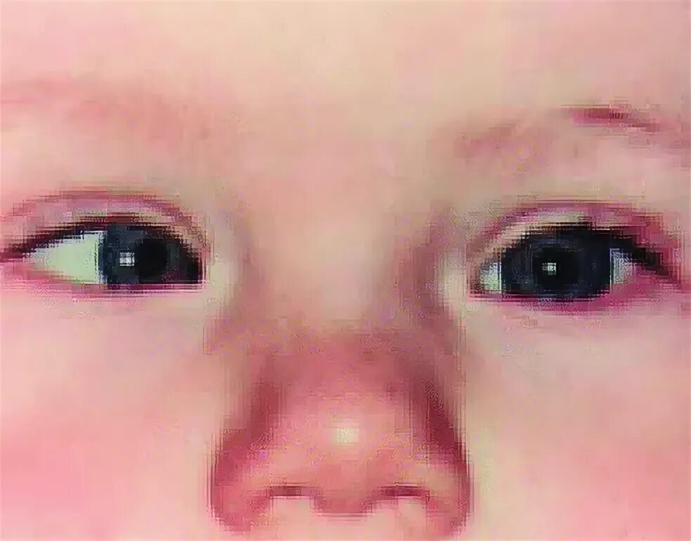Как выглядит косоглазие у детей до года How to Treat Strabismus (Crossed Eyes) Vision therapy exercises, Vision therapy,