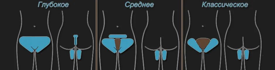Бикини что находится в тихом. Зона депиляции тотальное бикини. зона бикини эпиляция классическое. зона глубокого бикини и классического. бикини классика.