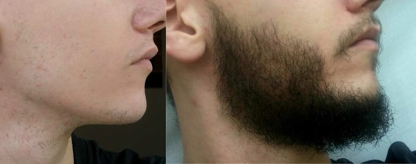Растут ли волосы быстрее. Миноксидил 5 % alerana для бороды. Миноксидил Генеролон для бороды. Миноксидил для волос для мужчин для бороды.