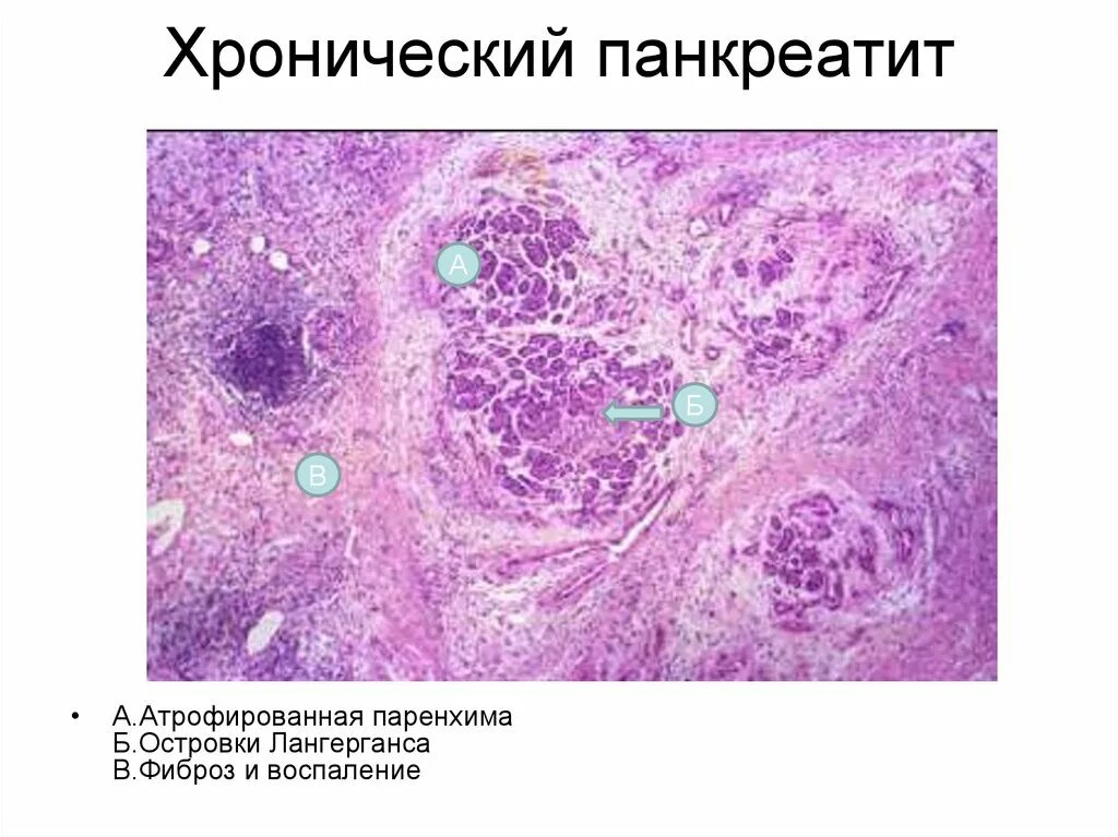 Поджелудочная железа фиброзные изменения. Хронический панкреатит макропрепарат. Хронический индуративный панкреатит гистология. Панкреонекроз препарат патологическая анатомия. Опухоли поджелудочной железы гистология.