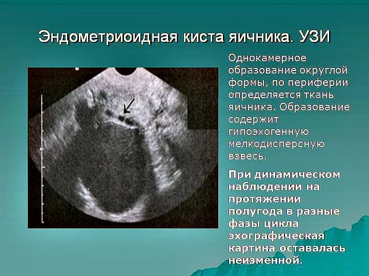 Эндометриоидные кисты яичника. Эндометриоидная киста яичника на УЗИ. Эндометриоидные кисты яичников УЗИ. Эндометрия скудная