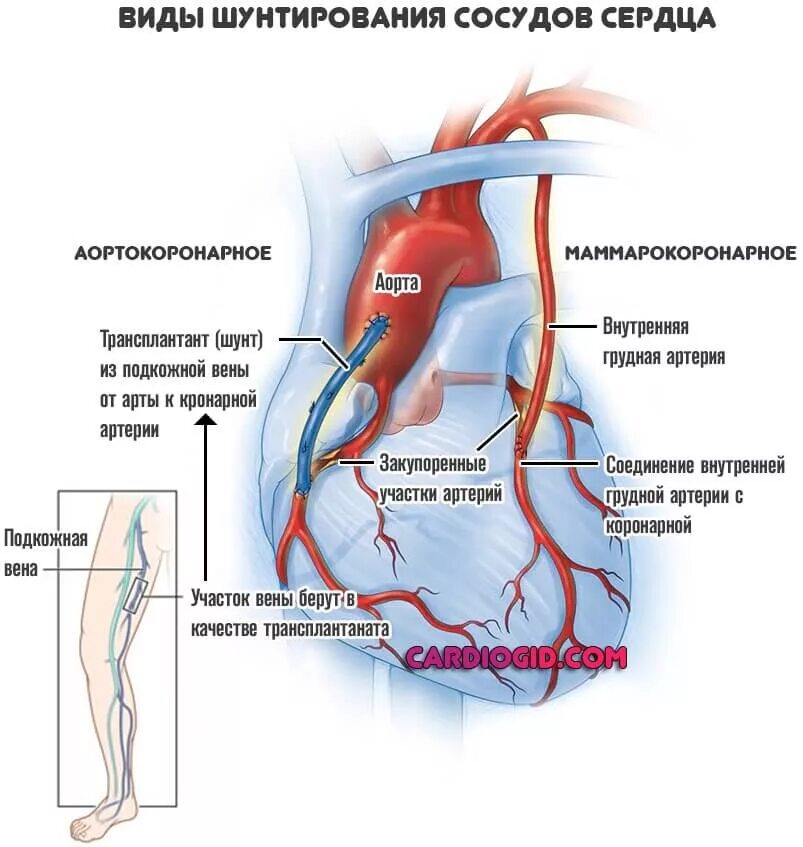 Шунтирующие сосуды. Шунтирование коронарных артерий. Схема операции аортокоронарного шунтирования. Стентирование коронарных артерий схема. Операция шунтирование сосудов сердца.