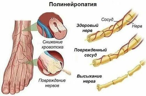 Классификация диабетической полинейропатии нижних конечностей. Диабетическая нейропатия нижних конечностей симптомы. Полиневропатия конечностей симптомы. Поражение сенсорных волокон нервов нижних конечностей. Ишемия нерва