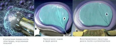 Нуклеопластика межпозвонкового диска