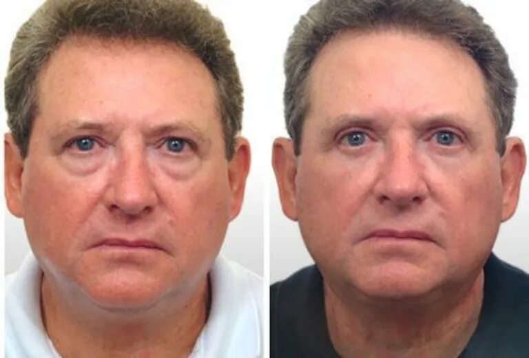 Удаление грыж под. Мишки пож глазами до и после. Жировые грыжи под глазами. Блефаропластика нижних век грыжи. Жировые мешки нижнего века.