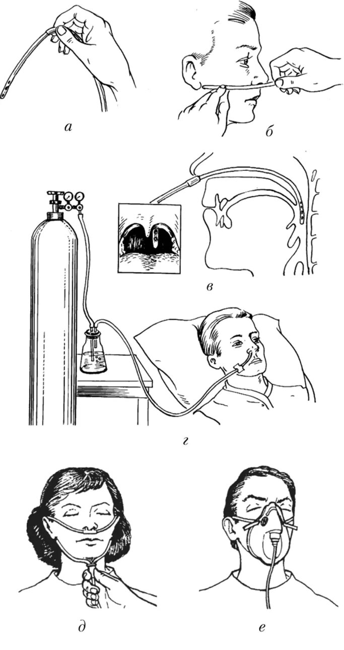 Алгоритм подачи кислорода через. Аппарат Боброва для оксигенотерапии. Носовой катетер для оксигенотерапии алгоритм. Оксигенотерапия алгоритм через канюлю. Оксигенотерапия назальная канюля.
