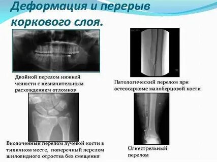 Деформация перелома