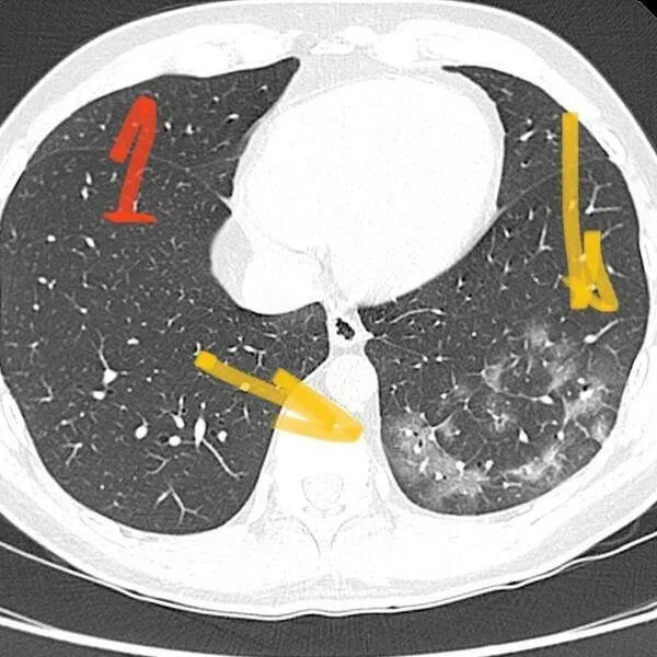 Кт легких ковид. Пневмония кт матовое стекло. Ковид пневмония кт. Матовое стекло при ковид на кт.