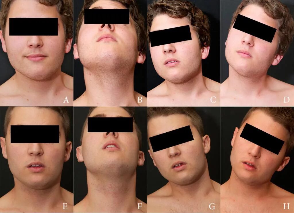 Недоразвитие верхней челюсти. Асимметрия у подростков. Человек в фас. Недоразвитие верхней челюсти. Синдром парри ромберга.